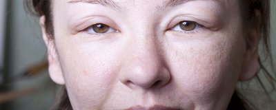 ​水肿脸与脂肪脸区别